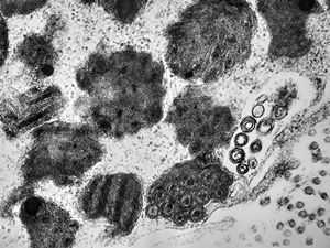 F,31y. | mast cell - granules with scroll-like formations - n. suralis, demyelinating neuropathy F,31y. | mast cell - granules with scroll-like formations - n. suralis, demyelinating neuropathy